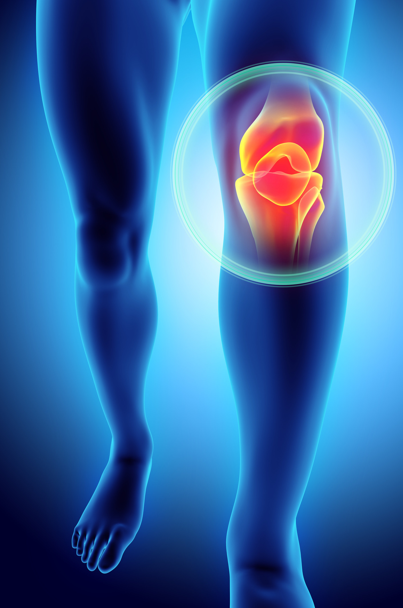 Knee arthritis